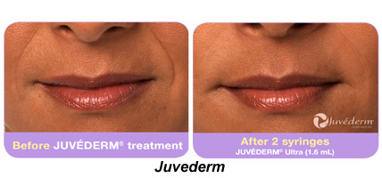 Juvederm