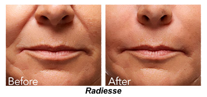 Radiesse