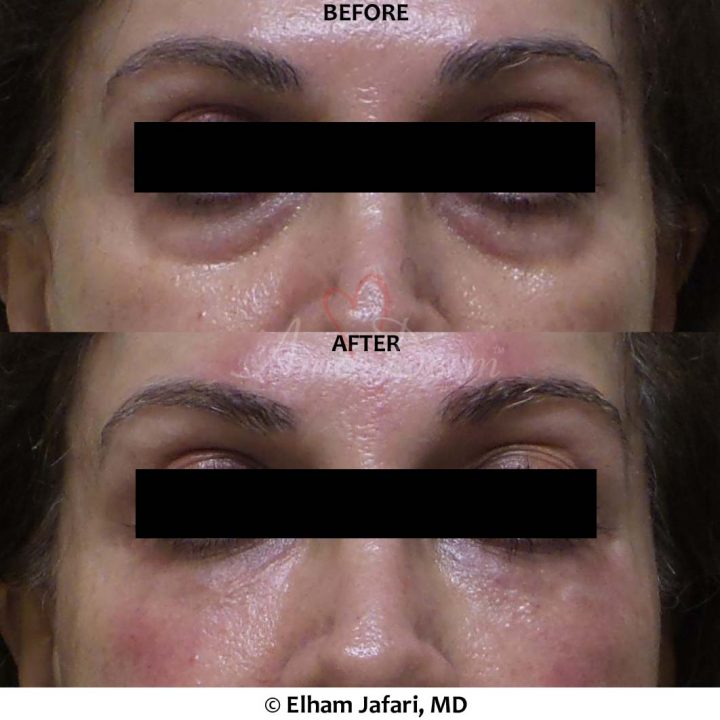 Volbella Juvederm Fillers for Lip Augmentation in Irvine & Newport Beach