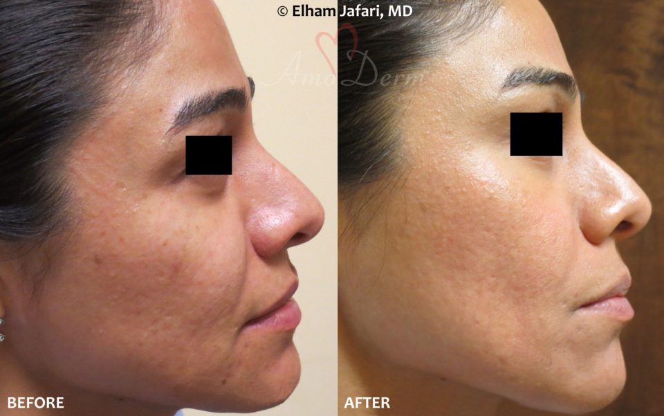 Fractional CO2 Laser Skin Resurfacing