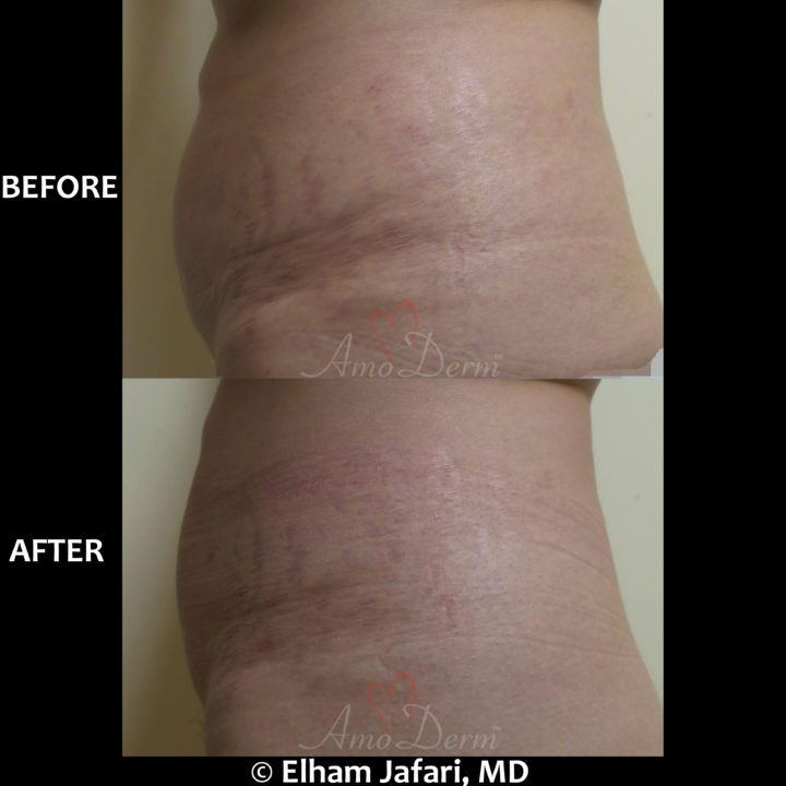 Treatment of stretch marks with Fractional CO2 laser (CO2 Laser Skin Resurfacing)