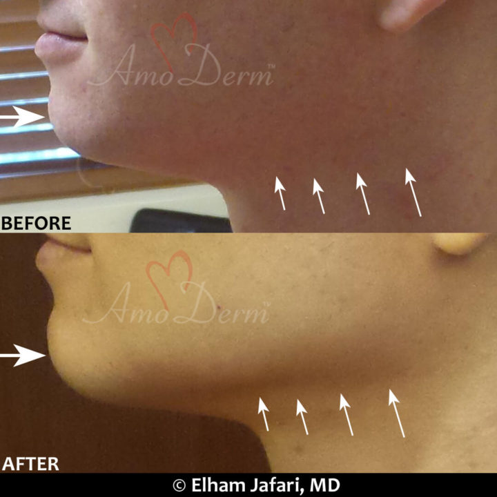 Jawline contouring and chin augmentation with dermal fillers