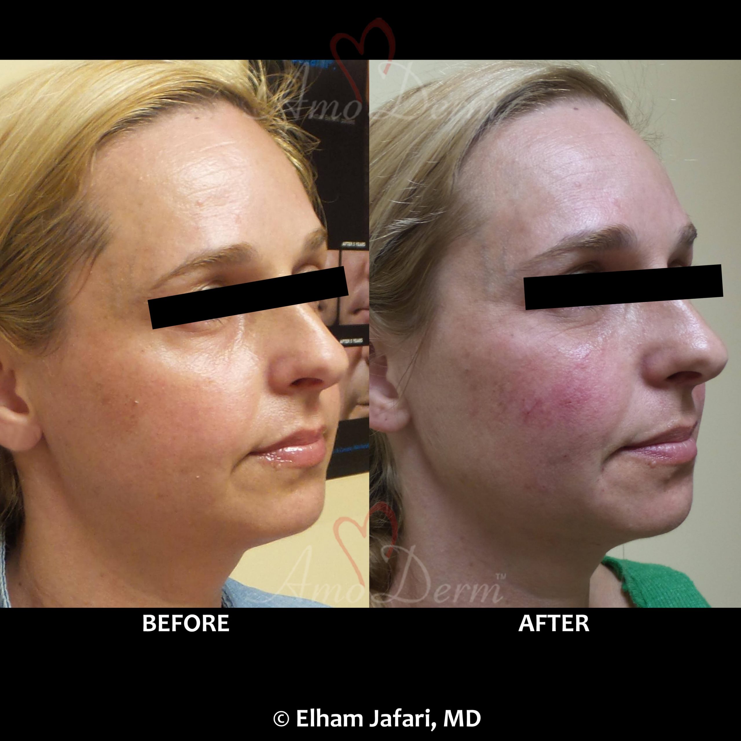 Liquid facelift with dermal filler