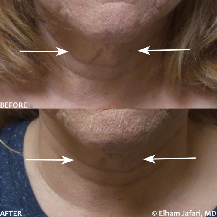 Nonsurgical skin tightening and lifting with Ultherapy