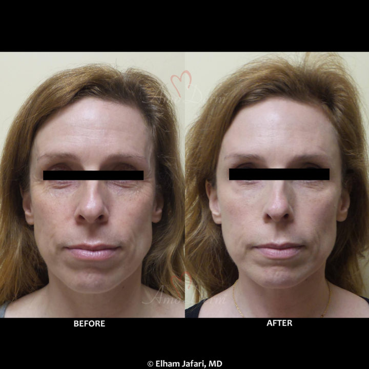 Liquid Facelift with filler in temples, cheeks &amp; under eyes, forehead and crow&#039;s fit