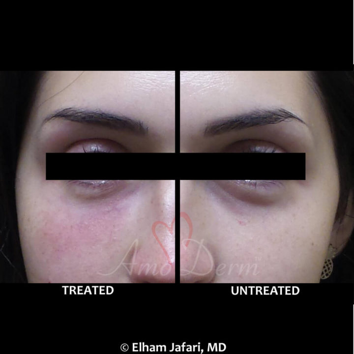 Nonsurgical treatment of dark circles, bags and hollows under the eyes