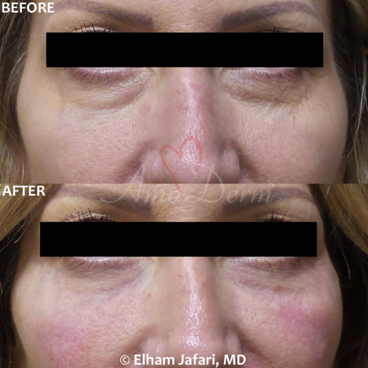 Nonsurgical treatment of dark circles, bags and hollows under the eyes