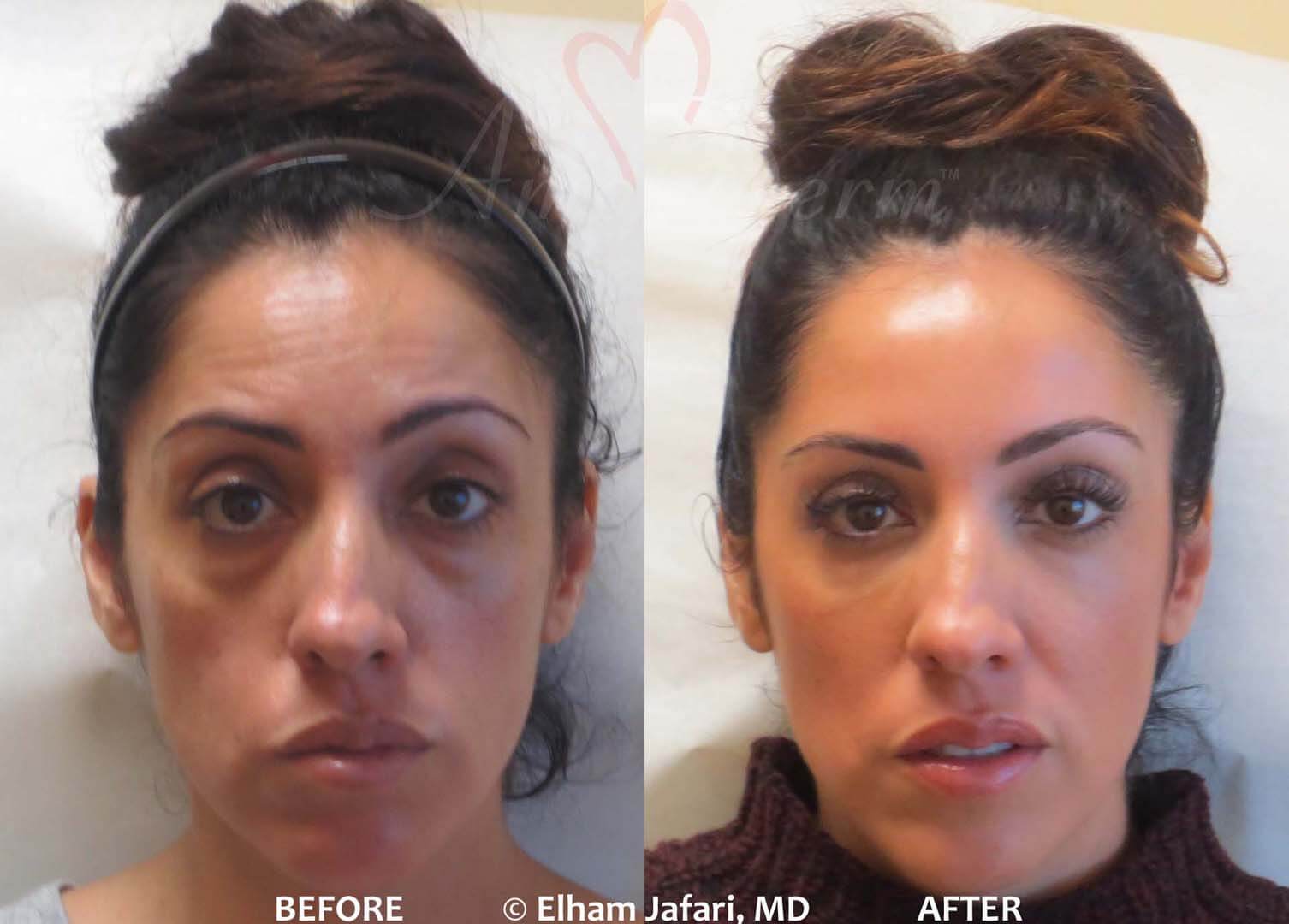 Dr. Mitesh Kapadia - Boston Eyelid Surgery - Not all eye bags are caused by  excess fat under the eyes. This is a case of filler gone wrong. In a small  subset