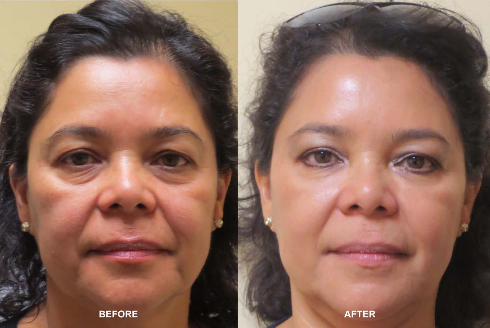 4D Under Eye Lift to treat dark circles under eyes & contour cheeks