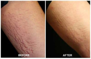 Stretch Mark Removal Arms Before After Treatment