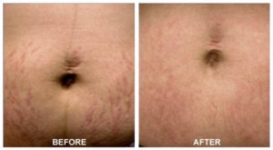 Stretch Mark Removal Belly Before After Treatment