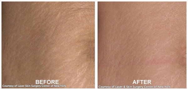 Stretch Mark Removal Body Before After Treatment