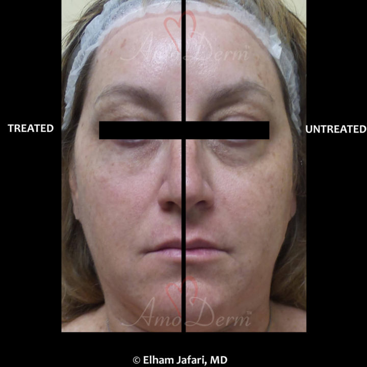 Nonsurgical treatment of dark circles, bags and hollows under the eyes