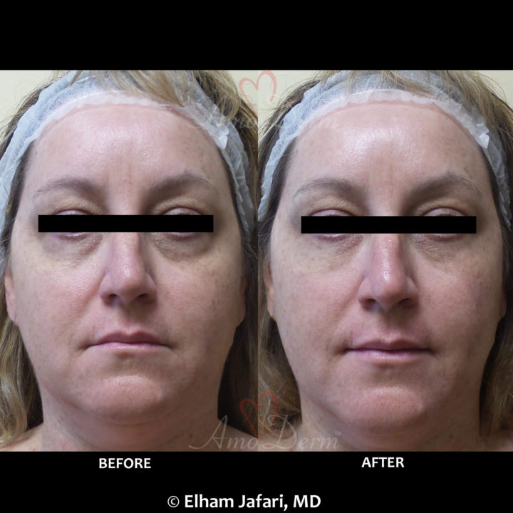 Nonsurgical treatment of dark circles, bags and hollows under the eyes