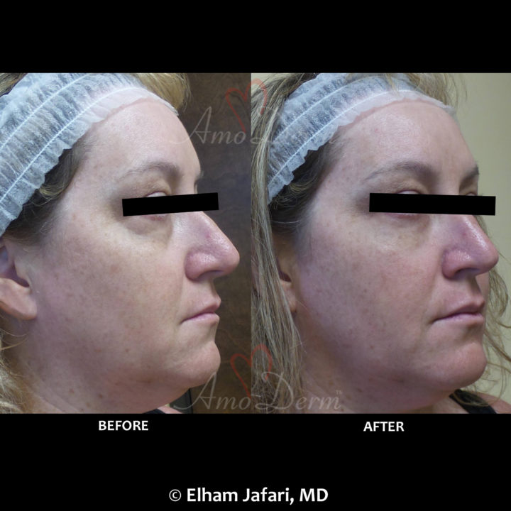 Nonsurgical treatment of dark circles, bags and hollows under the eyes