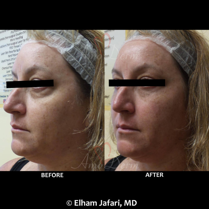 Nonsurgical treatment of dark circles, bags and hollows under the eyes