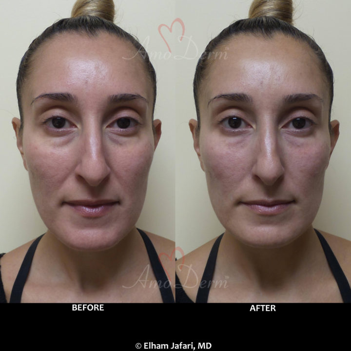 Nonsurgical treatment of dark circles, bags and hollows under the eyes