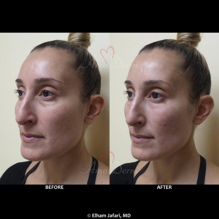 Nonsurgical treatment of dark circles, bags and hollows under the eyes