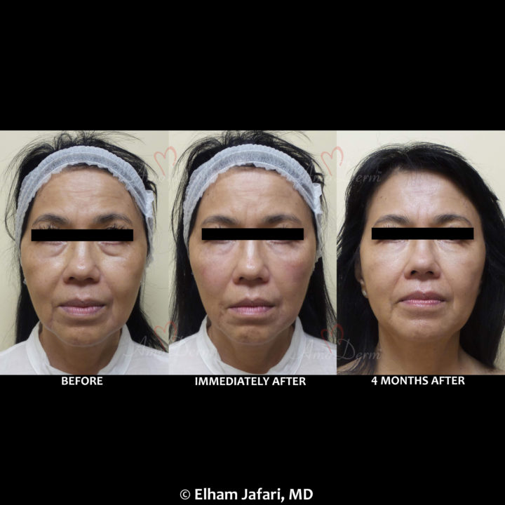 Nonsurgical treatment of dark circles, bags and hollows under the eyes