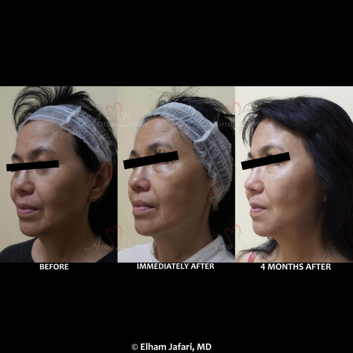 Nonsurgical treatment of dark circles, bags and hollows under the eyes