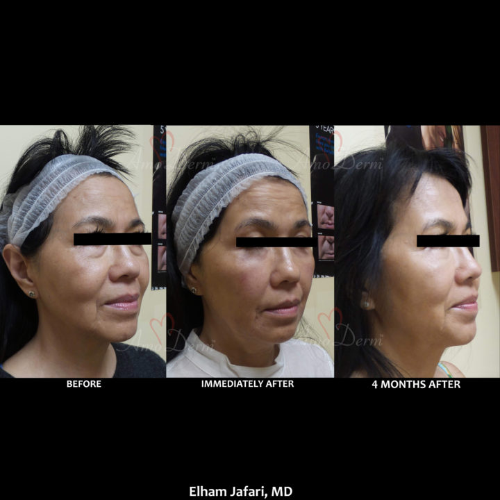 Nonsurgical treatment of dark circles, bags and hollows under the eyes