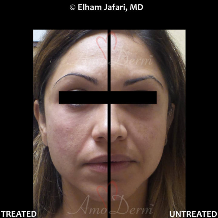 Nonsurgical treatment of dark circles, bags and hollows under the eyes