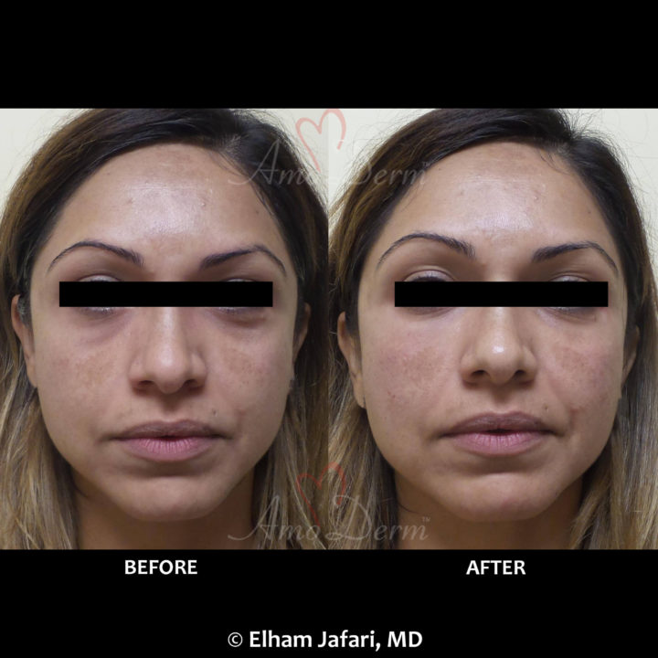 Nonsurgical treatment of dark circles, bags and hollows under the eyes