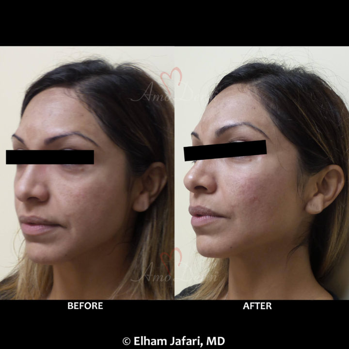 Nonsurgical treatment of dark circles, bags and hollows under the eyes