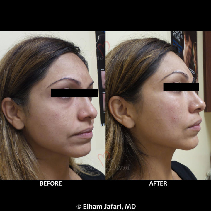 Nonsurgical treatment of dark circles, bags and hollows under the eyes