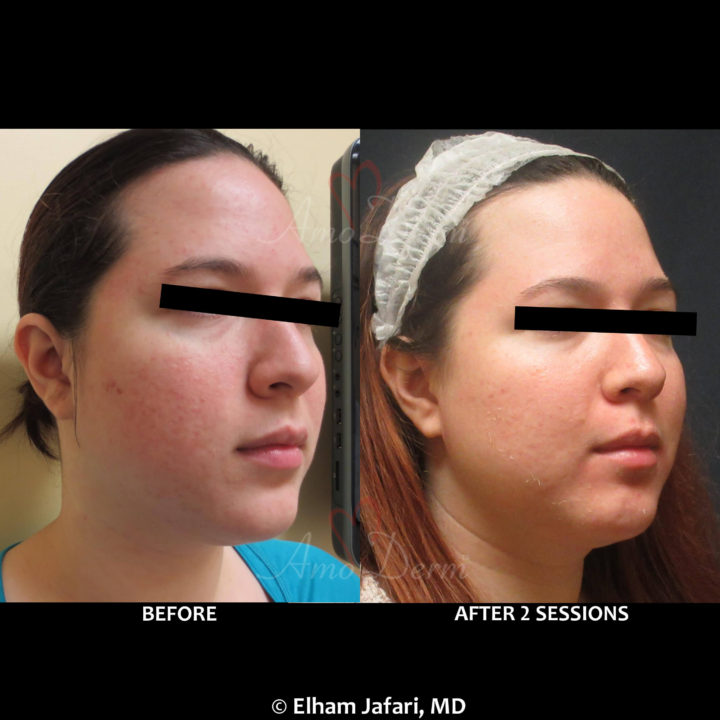 Treatment of acne scars with Fractional CO2 laser skin resurfacing