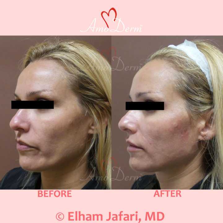 Liquid Facelift with PDO Thread in mid and lower face