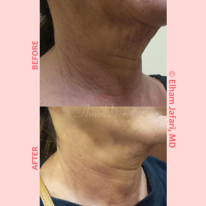 Non-surgical neck lift, skin tightening and rejuvenation with Ultherapy