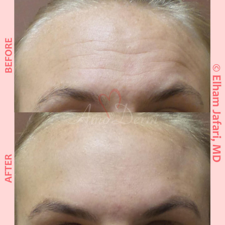 Treatment of lines and wrinkles in forehead, glabella, frown lines &amp; crows feet