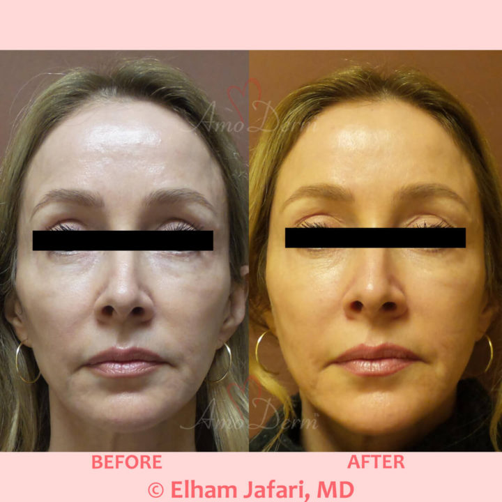 Liquid Facelift with filler injection in temples, cheeks and nose &amp; Botox between eyebrows, crow&#039;s feet, forehead &amp; upper lip