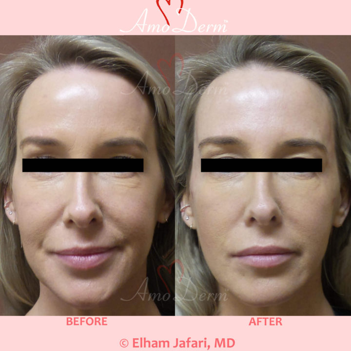 Liquid Facelift with filler injection in the temples