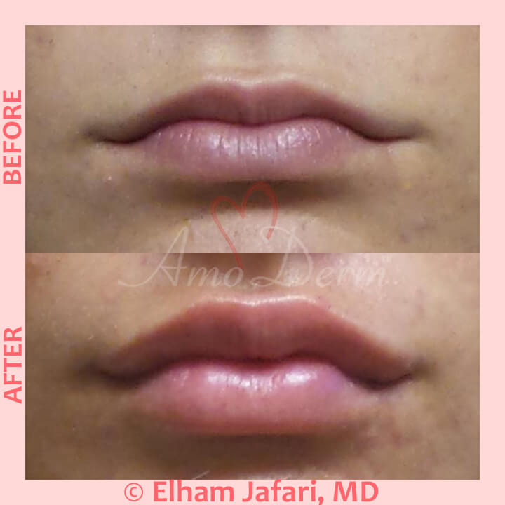 The smart Trick of Los Angeles Lip Augmentation Fillers Fat Transfer That Nobody is Discussing thumbnail