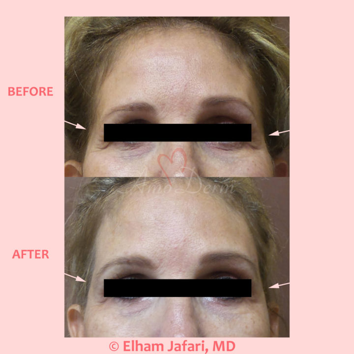 Volume restoration in temples with filler injection (Juvederm, Restylane, Voluma, Sculptra)