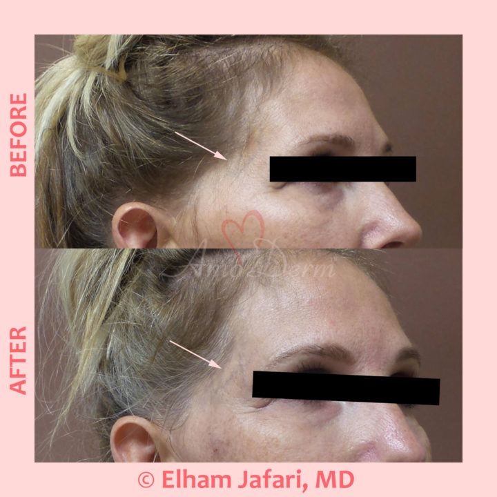 Volume restoration in temples with filler injection (Juvederm, Restylane, Voluma, Sculptra)