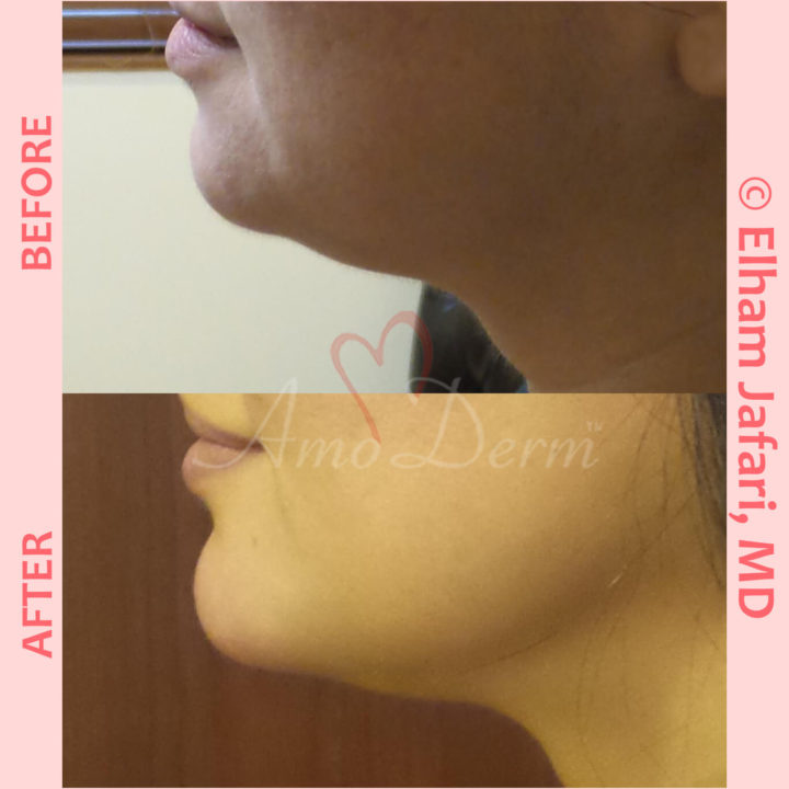 Non surgical reduction of double chin with Kybella &amp; Chin augmentation with filler injection (Voluma, Bellafill, Radiesse)