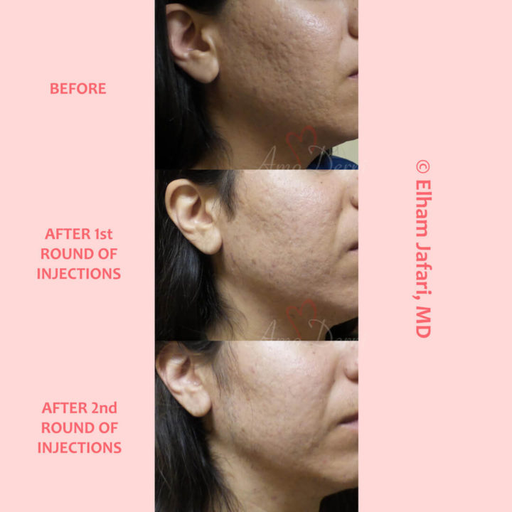 Treatment of acne scarring and other types of scars with Bellafill injection