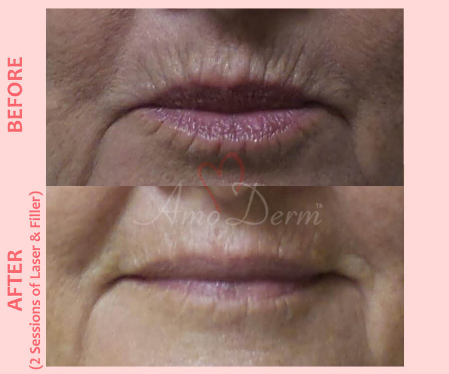 Treatment for smoker&#039;s lines above upper lip with filler injection and Erbium laser