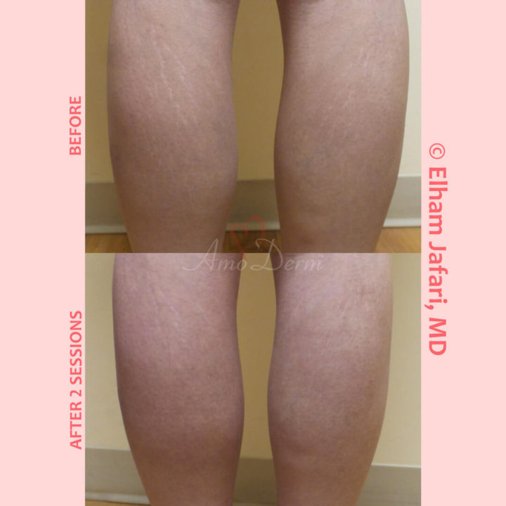 Treatment of stretch marks with Fractional CO2 laser (CO2 laser skin resurfacing)