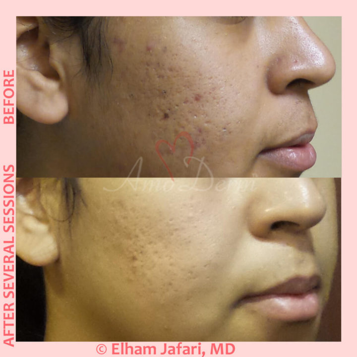 Treatment of acne scarring and other types of scars with micro-needling