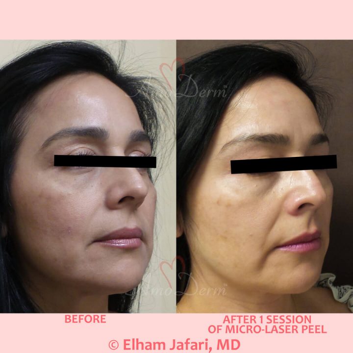 Microlaser Peel - Erbium laser skin resurfacing