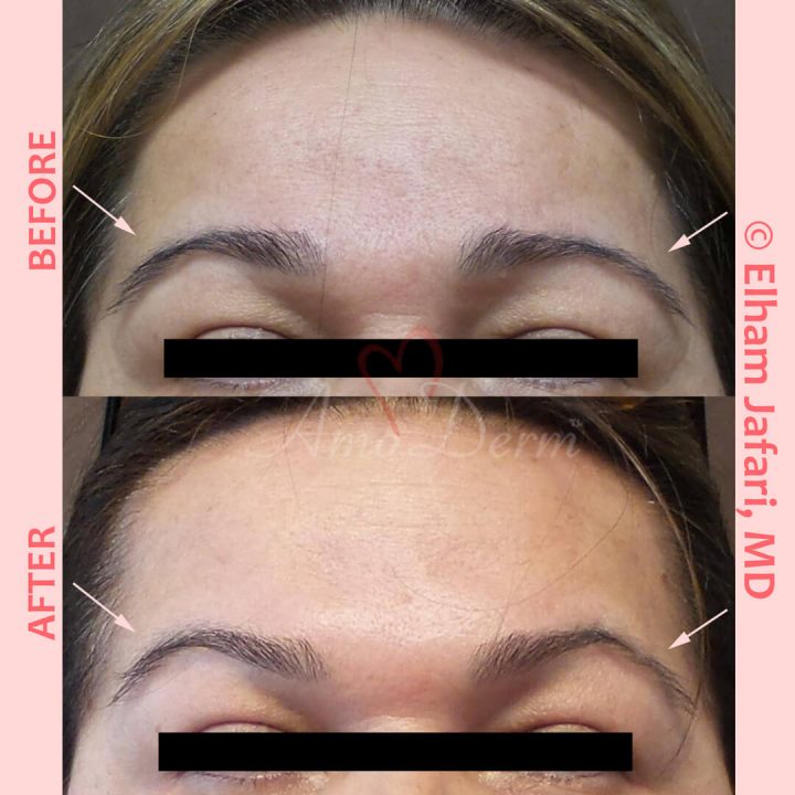 Non-surgical eyebrow lift and treatment of lines in forehead