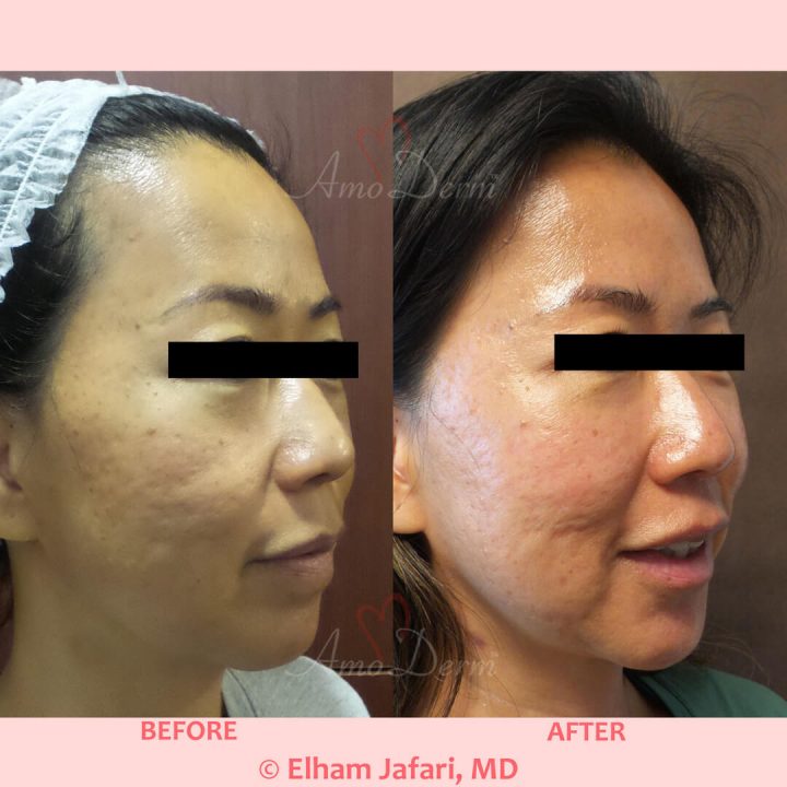 Liquid Facelift - Cosmetic Treatments in Irvine, Orange County