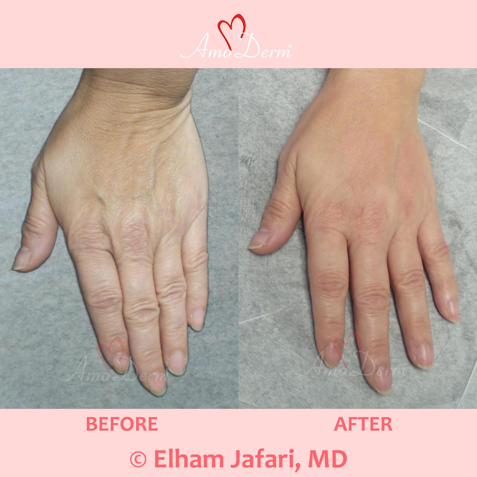 Irvine Newport Beach Hand Rejuvenation Orange County Fillers