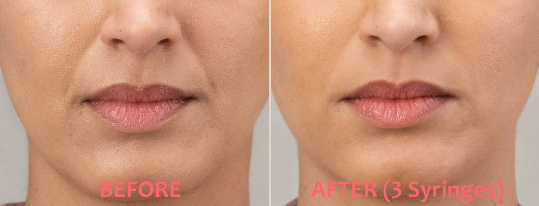 RHA Filler Before & After