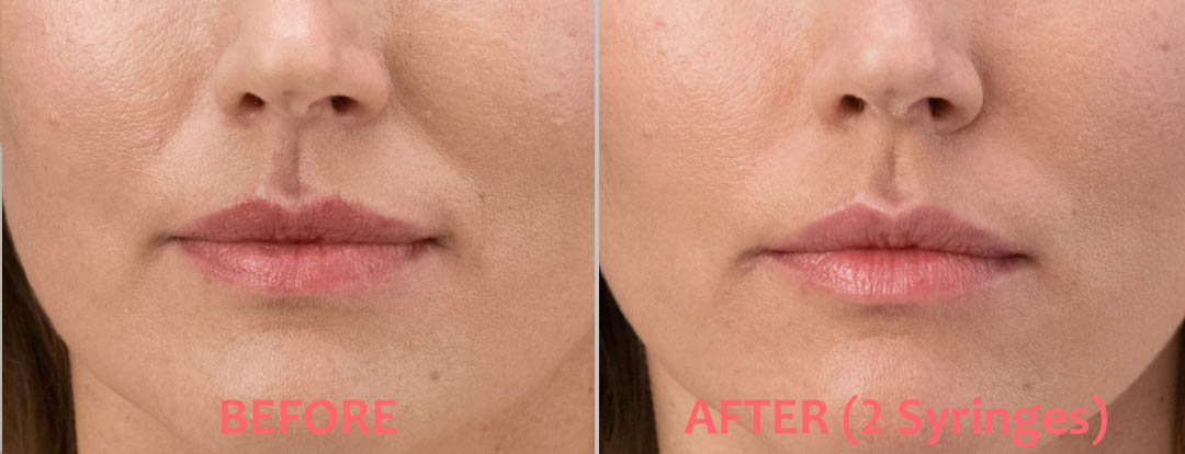 RHA Filler Before & After