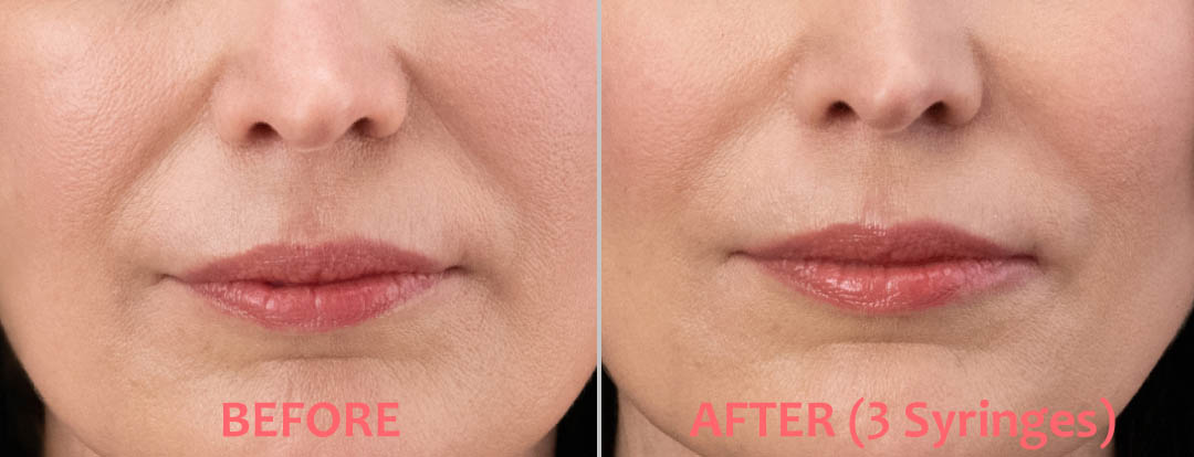 RHA Filler Before & After